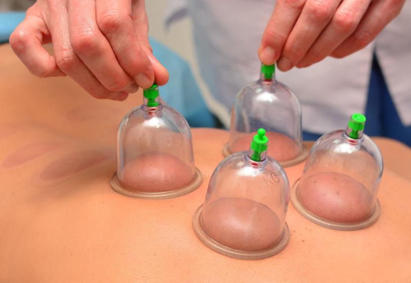What you Must Know about Cupping Therapy