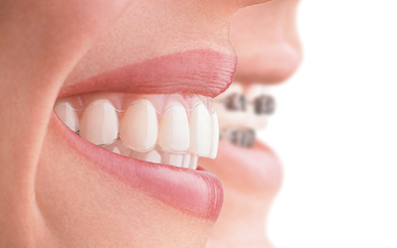 All That You Must Know About Invisible Braces and Invisalign