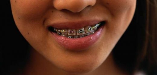 Five Common Signs you Need Braces