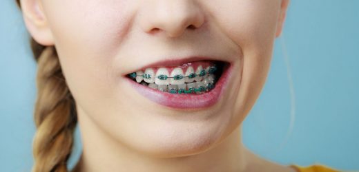 How to Manage Braces – Tips for Adults