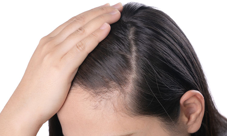 The emotional toll of female pattern baldness
