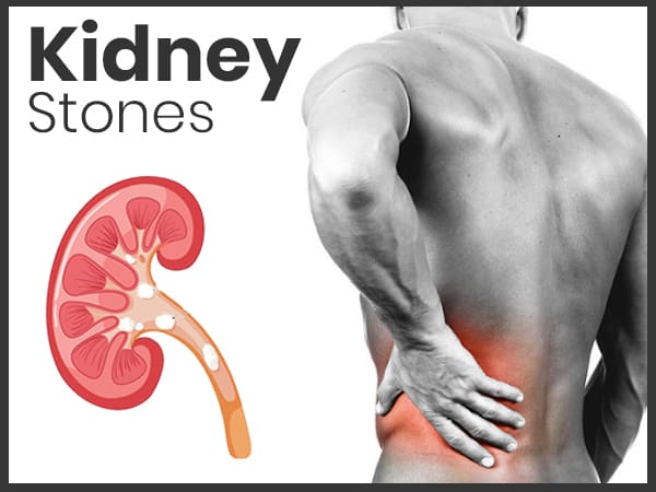 Natural Remedies for Kidney Stone Pain: How to Soothe Your Pain at Home