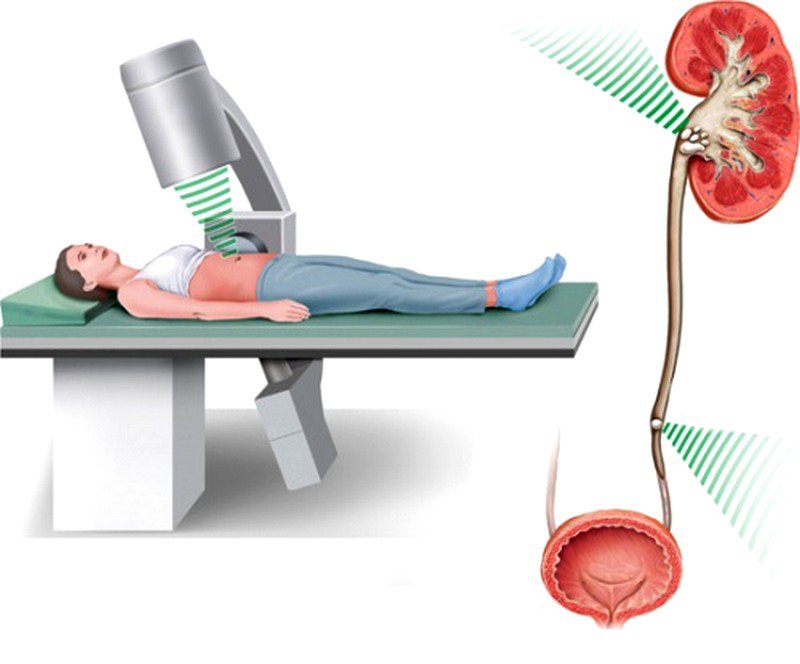 Maximizing Patient Comfort with Thulium Laser Lithotripsy in Kidney Stone Treatment
