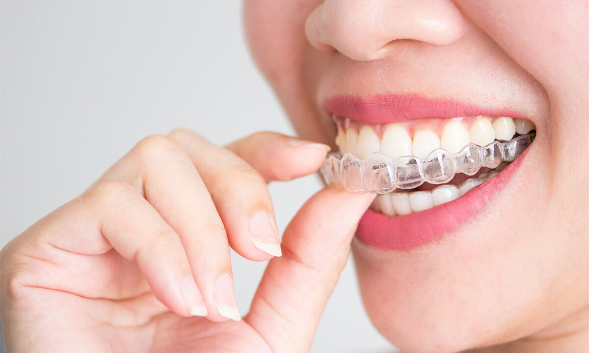 Invisalign: A Path-breaking Dental Innovation