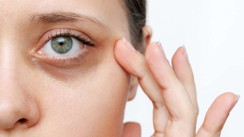 Ultimate Guide to Getting Rid of Dark Eye Circles for Good